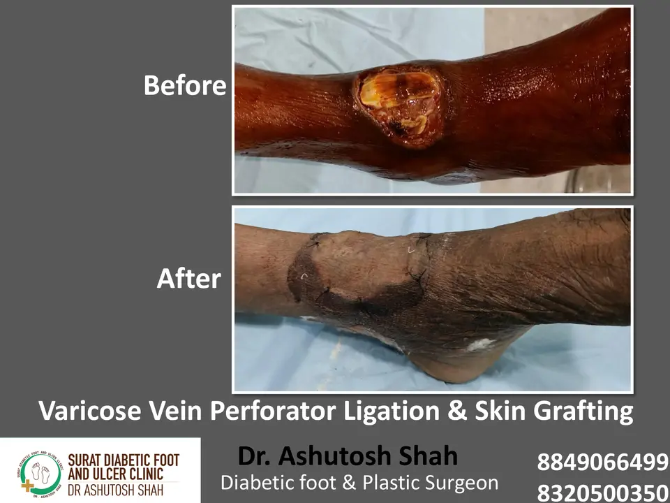 Varicose veins and Ulcers.pptx-13.webp